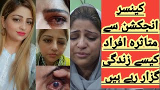 Eye Injection victim miseries Injection  Cancer injection  Eye sight Sehat by ummay e farwah [upl. by Race511]