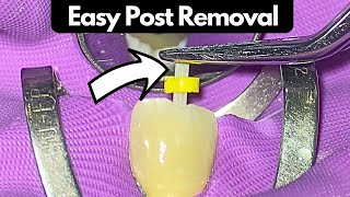 Efficient Fibre Post Removal Technique A StepbyStep Guide [upl. by Kcim]