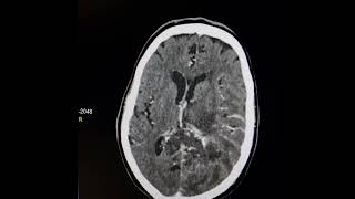 Butterfly glioblastoma multiforme of corpus callosum [upl. by Mosnar]