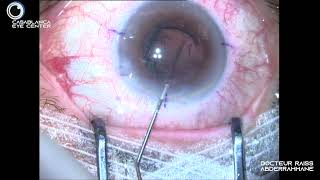 CATARACTE Rupture périphérique sans vitrectomie Implant sulcus  irrido L [upl. by Rudiger]