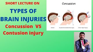 TYPES OF BRAIN INJURY CONCUSSION VS CONTUSION [upl. by Woodhouse]