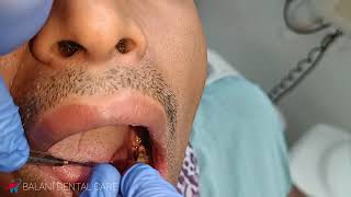 patient suffering from pain Tooth Extraction 37 for relief the pain Inferior alveolar nerve Block [upl. by Aknahs]