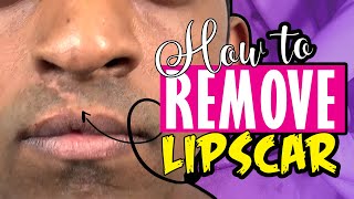 How to remove lip scar improve shape and make in more luscious  permanent facial plasticsurgery [upl. by Eisyak997]