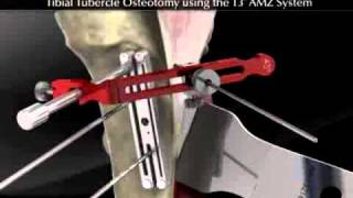 Tibial Tubercle Osteotomy using the T3 AMZ System [upl. by Michail]