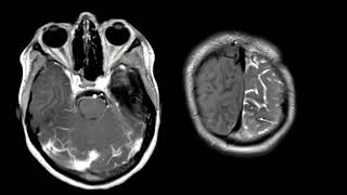 JID January 2024 Cover Radiological Findings in GNAQGNA11 Mosaicism [upl. by Meekyh467]