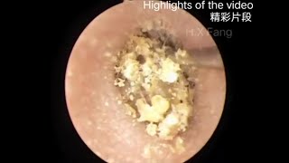 Easy earwax removal（简单的耳屎清理）20230822 [upl. by Jayne]