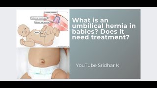 Umbilical hernia in babieswhat is it Does it need any treatment umbilicalhernia umbilicalcord [upl. by Odanref]