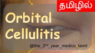 ORBITAL CELLULITIS  தமிழில்  Ophthalmology  MBBS [upl. by Eruza474]