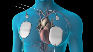 Cardioversion for Atrial Fibrillation [upl. by Luapnhoj]