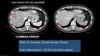 Interpreting CT Abdo Background Liver Hepatic Steatosis High Attenuation Liver [upl. by Kolivas]