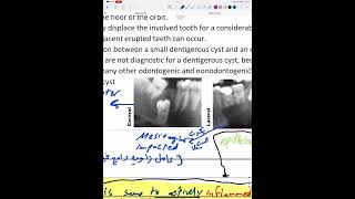 Odontogenic cysts 1 part 1 [upl. by Accebar]