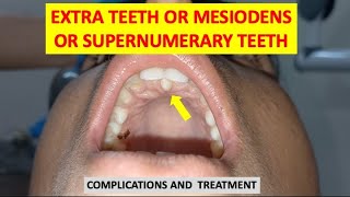 SUPERNUMERARY TEETH MESIODENS EXTRA TEETH COMPLICATIONS AND TREATMENT dentalcafe4331 [upl. by Eener]