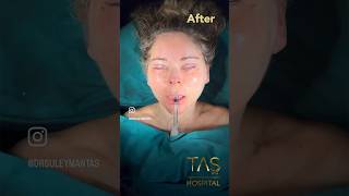 Scarless facelift and necklift blepharoplasty by DrTAS plasticsurgeon tasmedicalcenter [upl. by Asare]