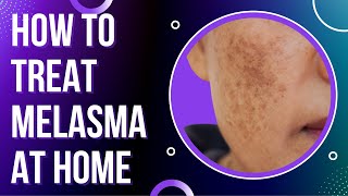 How to treat MELASMA at Home  Treat DARK SPOTS amp PATCHES on the skin [upl. by Sarchet]