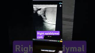 testicular ultrasoundright epididymal cyst [upl. by Gan]