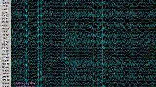 ELECTROENCEFALOGRAMA DE 32 CANALES INTERFAZ A PC EEG KT883200 YouTube 360p [upl. by Davy]