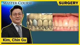 Master Course Season2 SURGERY Anterior Implant Placement amp Immediate Loading with OneGuide System [upl. by Maren335]