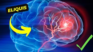 Eliquis The Revolutionary Anticoagulant for Stroke and Blood Clot Prevention [upl. by Disraeli]