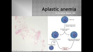 Aplastic anemia [upl. by Nwahsal697]