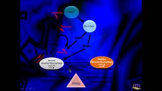 Internal Medicine Grand Rounds Sarcoidosis [upl. by Artenehs]