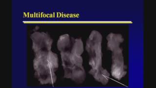 Breast Cancer Staging with Ultrasound [upl. by Arej]