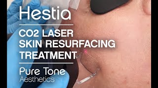 Laser Skin Resurfacing Treatment  Ready for radiant rejuvenated skin [upl. by Ruomyes]