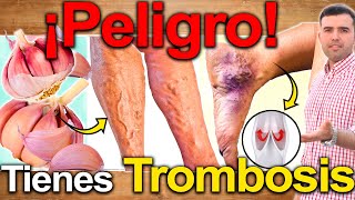 Síntomas De Trombosis Venosa  Signos Y Sintomas De Várices Y Mala Circulación Debes Saber [upl. by Domini249]