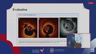 Day 3 Interventional Cardiology II [upl. by Ayatnahs]