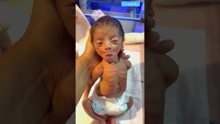 Premature Low Birth Weight 😮medical cutebaby viralvideo [upl. by Caprice886]