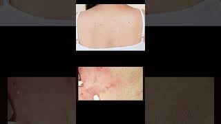 Back acne Pathology  Etiology  Pathogenesis  Clinical manifestations  Diagnosis amp Treatment [upl. by Aciemaj]