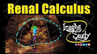 Renal Calculus  Nephrolithiasis  Twinkling Artifact  Ultrasound  Doppler  Case 248 [upl. by Tenay394]