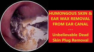 HUMONGOUS SKIN amp EAR WAX REMOVAL FROM EAR CANAL  EP70 relaxing satisfying asmr [upl. by Faubion]