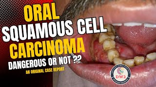 ORAL SQUAMOUS CELL CARCINOMA  HOW DANGEROUS OR LEATHAL IS IT  AN ORIGINAL CASE REPORT PART 1 [upl. by Convery]