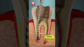 Root Canal Treatment 3D Animation shorts [upl. by Hnah806]