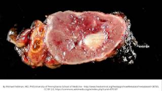 Pheochromocytoma [upl. by Adnolat596]