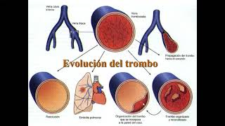 TEMA 3 Trastornos hemodinámicos parte 2 [upl. by Elleret338]