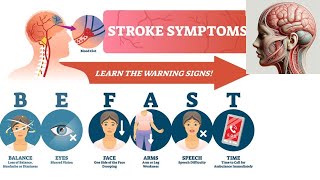 10 Stroke Warning Signs You Can’t Afford to Ignore – Act Now🧠 [upl. by Paff16]