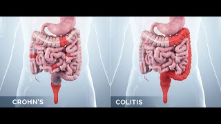 Inflammatory bowel disease crohns disease vs ulcerative colitis [upl. by Aniham]