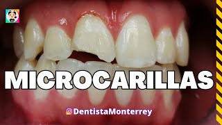 MICROCARILLA DENTAL de Porcelana👅microcarillas carillasdeporcelana [upl. by Bever]