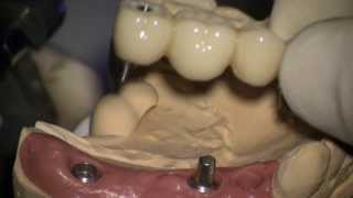 Dental implant Screw and cementretained provisional restoration setting 3 [upl. by Mingche684]