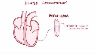 Dilated cardiomyopathy DCM causes symptoms diagnosis treatment amp pathology [upl. by Dodi74]