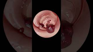 How gastrointestinal endoscopy is done [upl. by Aken524]