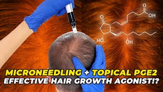 Microneedling  Topical PGE2 – The Most Effective Hair Growth Agonist [upl. by Adnawot]