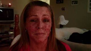 Skin Cancer My Vlogjournal Treatment W EFUDEX vid8 [upl. by Nylrem]