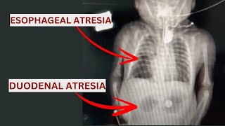 Esophageal Atresia amp Duodenal Atresia Qida borusu və Onikibarmaq bağırsaq Atreziyası [upl. by Mcroberts]