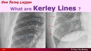 Kerley Lines on Chest PA Radiographs [upl. by Nahgiem]