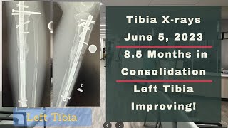 Height Journey  Tibia Xrays 85 Months In Consolidation  June 5 2023 [upl. by Lammond25]