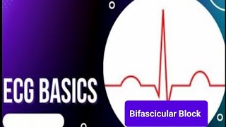 ECG Basics  Bifascicular Block  Electrophysiology and ECG criteria Bifascicular Block [upl. by Derby]