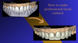 facial cutback EXOCAD [upl. by Namhar619]