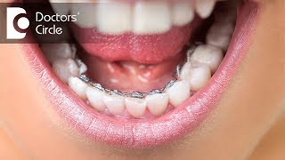 What are Lingual Braces amp when to go for it  Dr Nandini Nelivigi [upl. by Kelcie225]